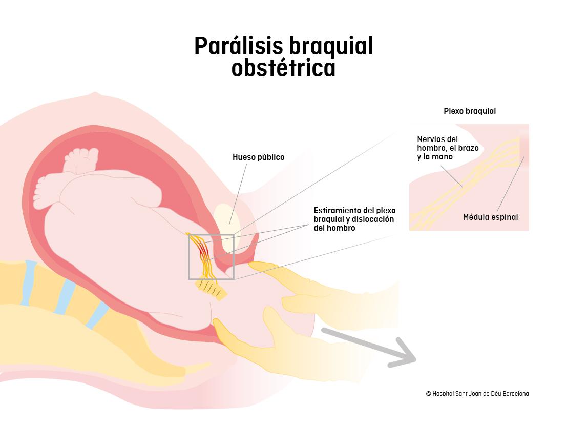 Parálisis braquial obstétrica | Escola de Salut SJD