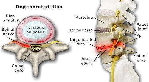 Understanding Degenerative Disc Disease: Causes, Symptoms, and Treatment  Options: Remi Ajiboye, MD, MPH: Minimally Invasive Spine Surgeon