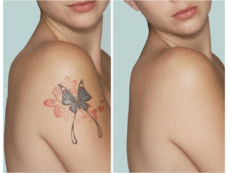 tattoo removal santa barbara