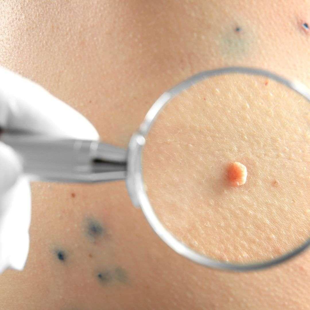 Tag & Mole Removal - Medical Treatments - Dubai - Swan Aesthetic Clinic