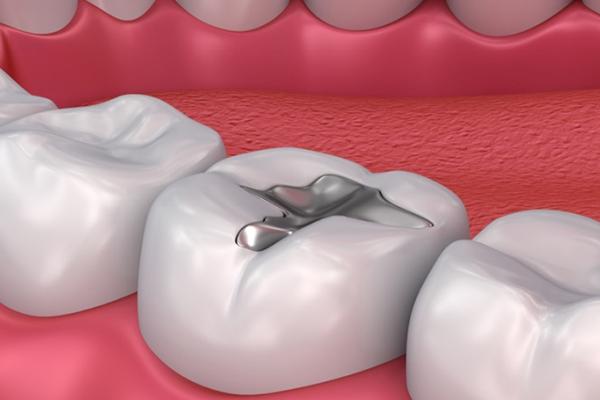 Understanding Tooth Fillings: A Comprehensive Guide