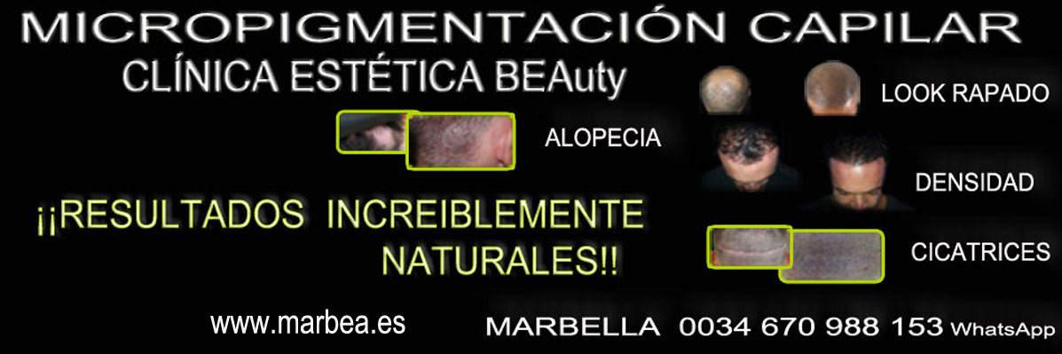 TATUAJE CAPILAR EN MÁLAGA CLINICA ESTÉTICA tatuaje capilar Málaga y Marbella y maquillaje permanente en marbella