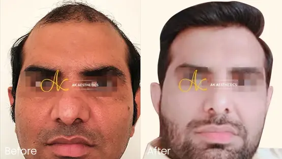 Best Hair Transplant In Jaipur Best Hair Transplant In Jaipur