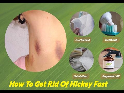 ways to remove a hickeys instantly