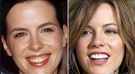 best teeth whitening products that actually work