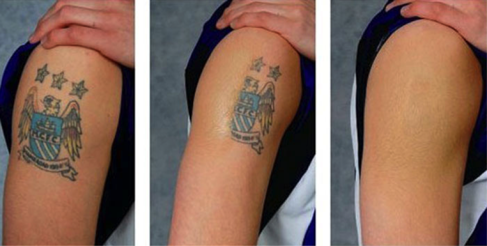 laser tattoo removal santa barbara