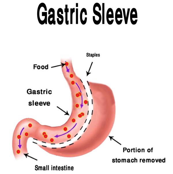 Gastric-Sleeve.jpg