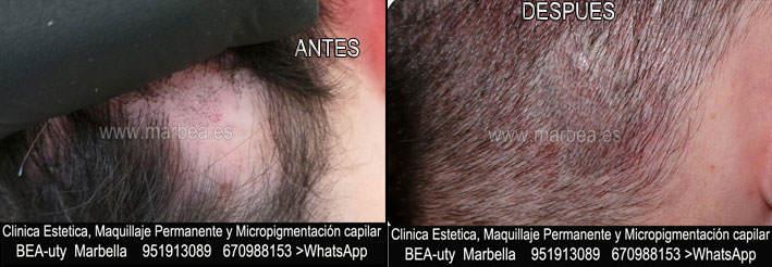 TATUAJE CAPILAR EN MÁLAGA CLINICA ESTÉTICA tatuaje capilar Málaga y Marbella y MAQUILLAJE PERMANENTE en MARBELLA