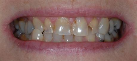 blekning av tänder med bikarbonat