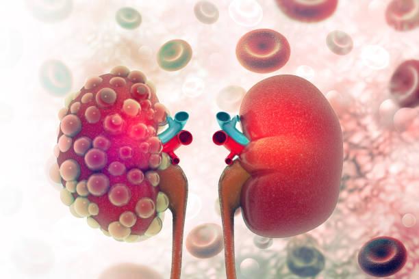 polycystic-kidney-treatment-in-ayurveda.jpg