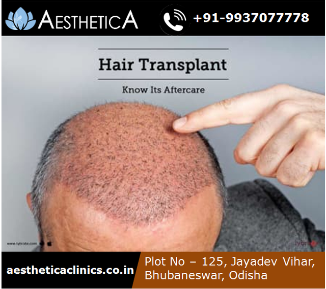 besthairtransplantclinicinindia.png