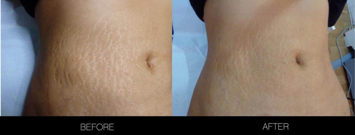 How To Get Rid Of Stretch Marks | Toronto | SpaMedica