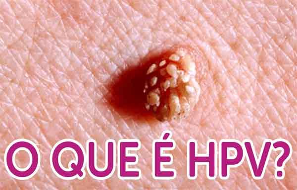 Papilomavírus-humano-HPV-Causas-sintomas-tratamento-Fotos-e-vídeos.jpg