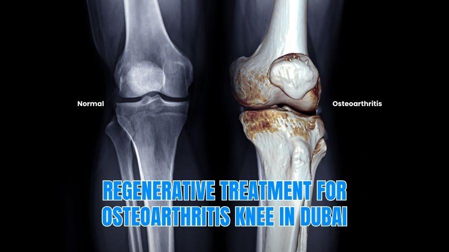 Knee Osteoarthritis Treatment in Dubai