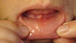 image from article, 10 Medication Side Effects That Can Affect Your Mouth