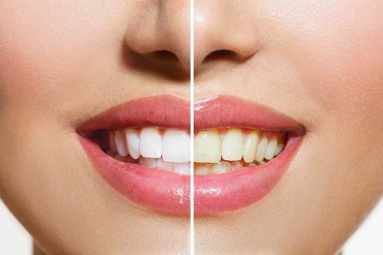teeth whitening powders
