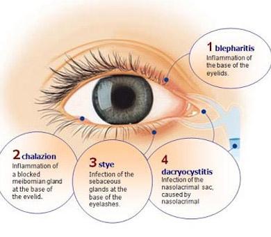 how to clean eyelids blepharitis