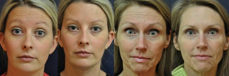Cosmetic Botox Injection Montreal ...