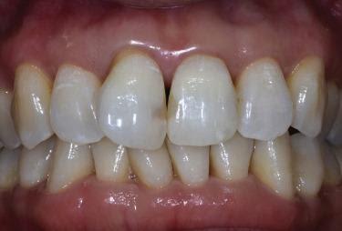 Sâu kẽ răng cửa: Phương án điều trị hiệu quả và tiết kiệm - nha khoa Thùy  Anh - nhakhoathuyanh