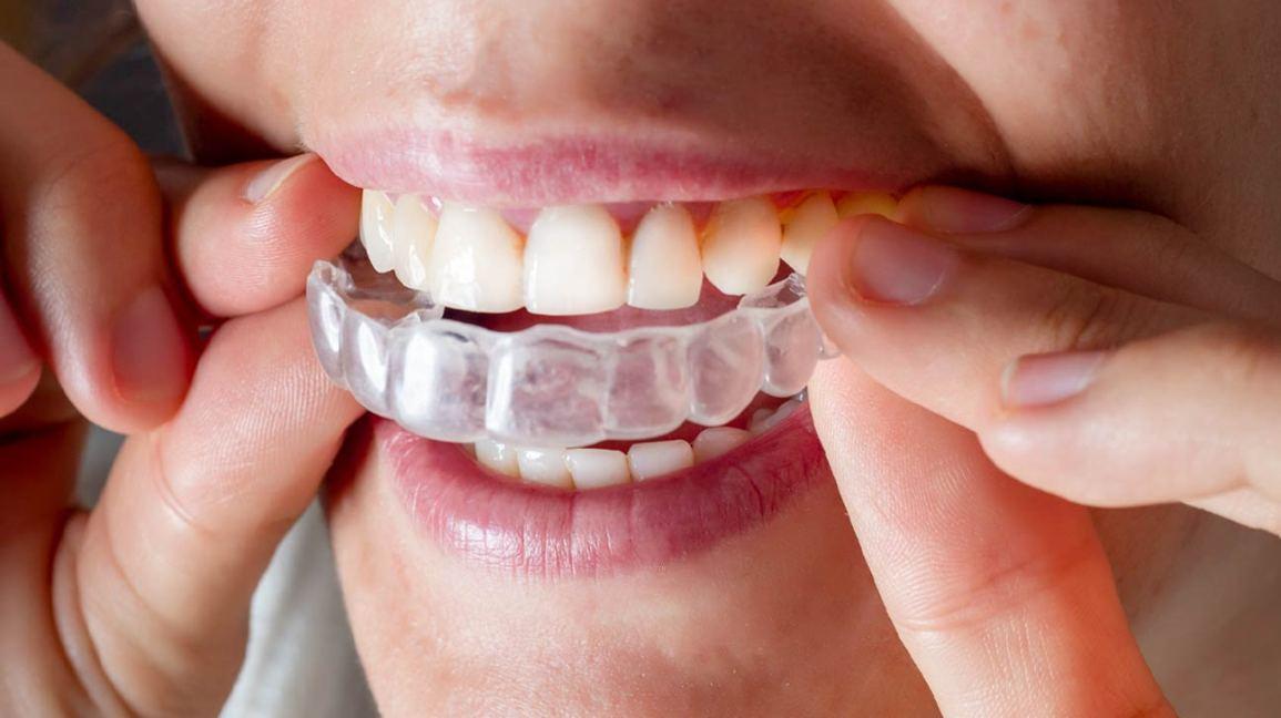 Invisalign and Fixing Overbites: How it Works, Timeline and More