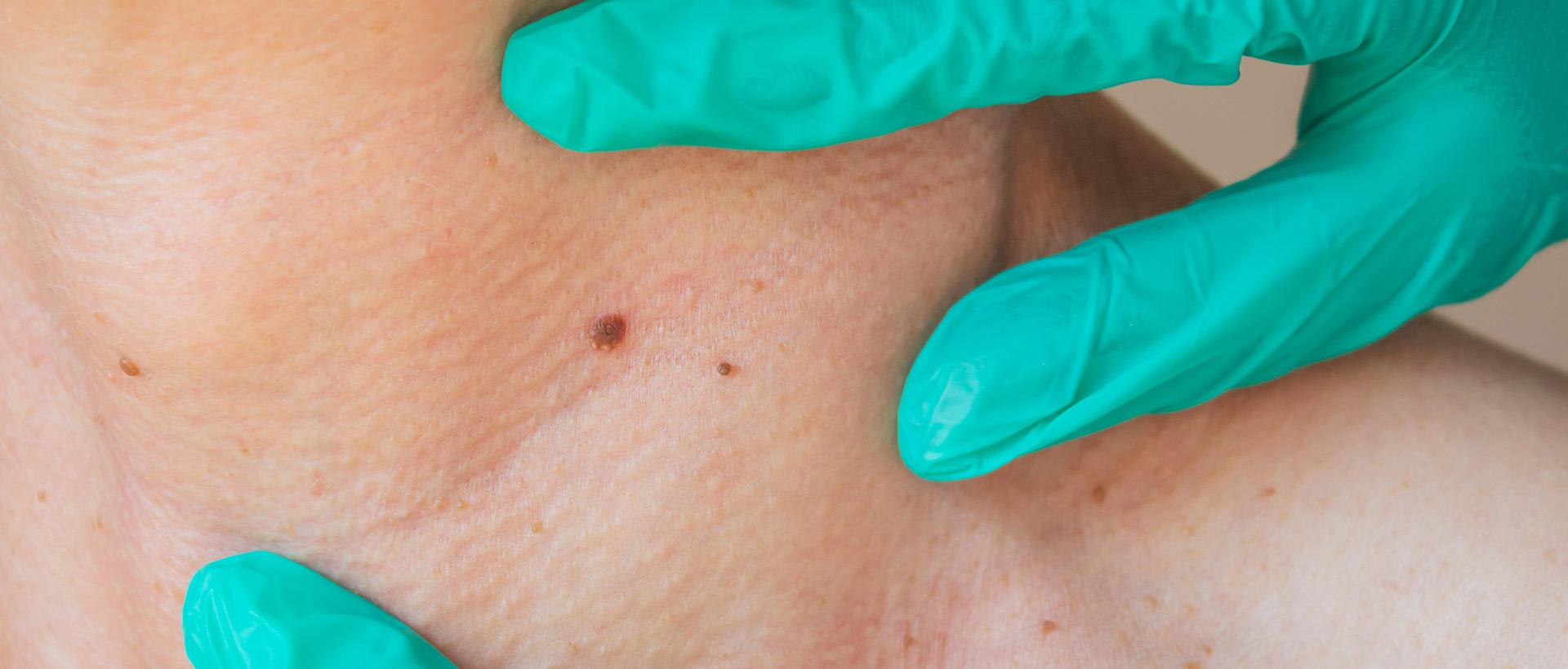Safe and Effective Skin Tag Removal Montreal, QC | Aura Dermatologie