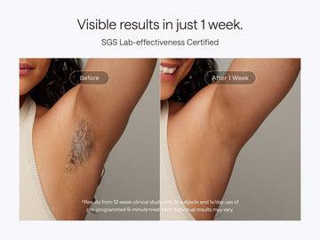 laser vs IPL hair removal