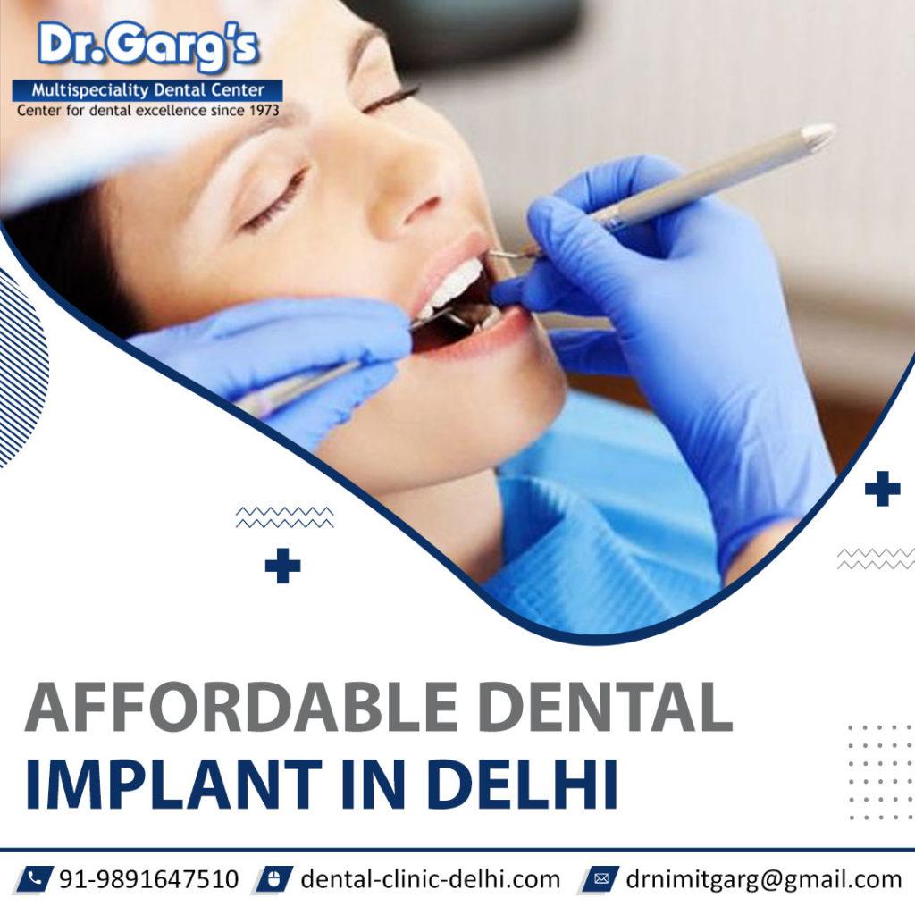 affordable dental implants in delhi
