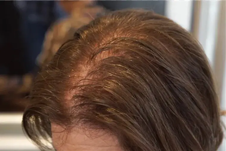 Scalp micropigmentation women