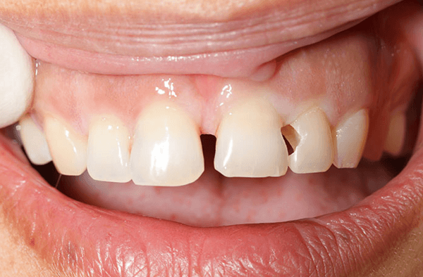 Sâu kẽ răng và phương pháp xử lý nhanh - hiệu quả - tiết kiệm -  nhakhoathuyanh