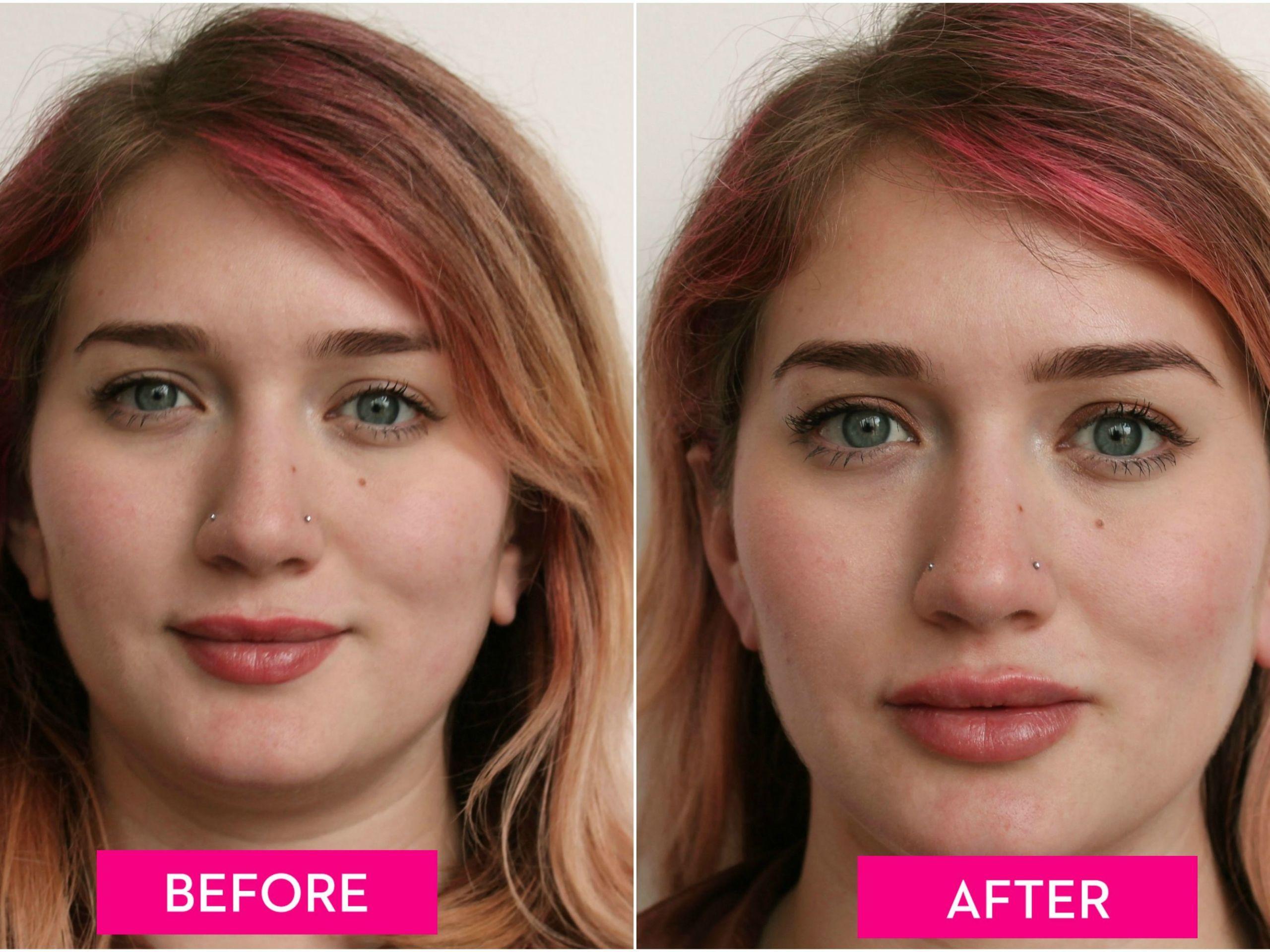 A Guide to Lip Injections, From the Cost to How They Feel - Before and  After Lip Fillers