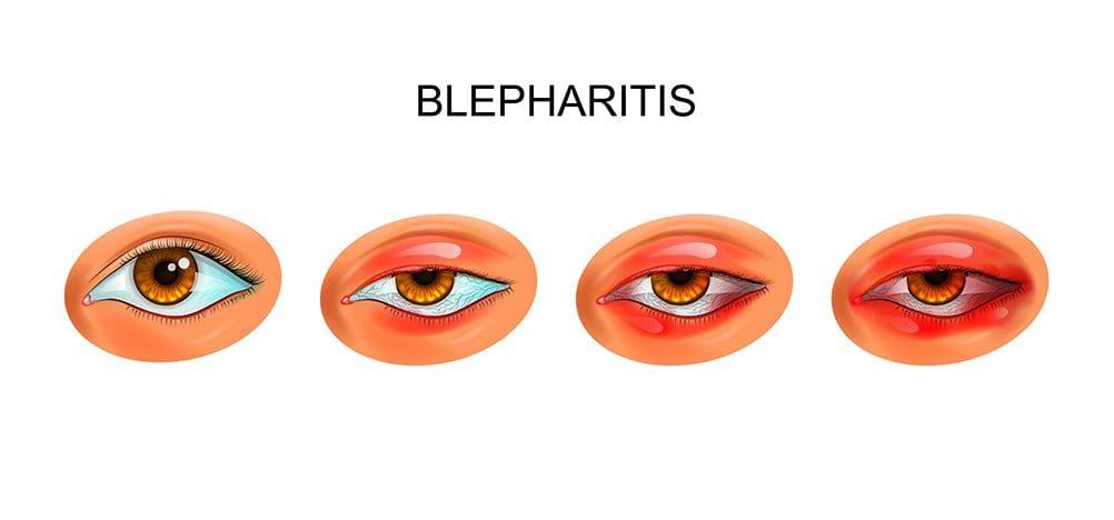 blepharitis and eye makeup