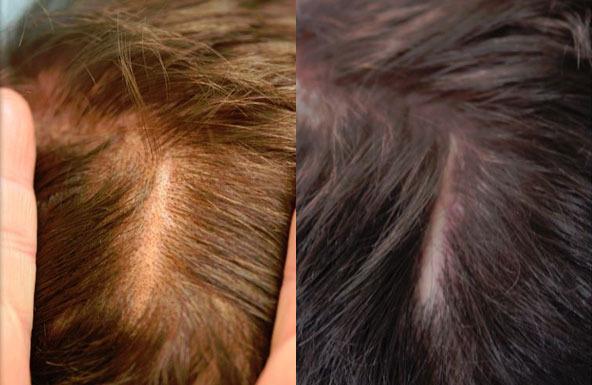 Scalp micropigmentation women