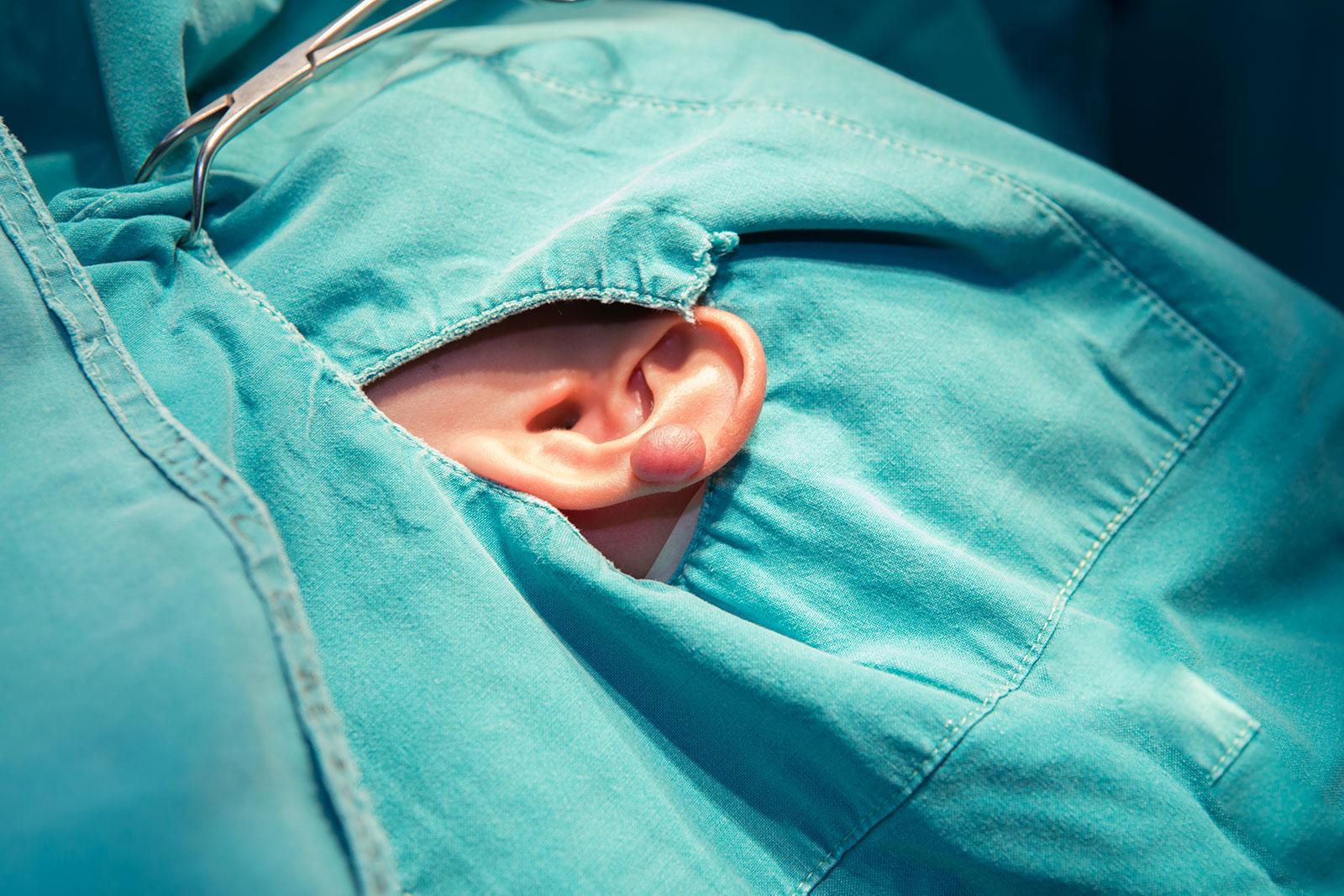 Keloid Scar Removal Atlanta Alpharetta GA