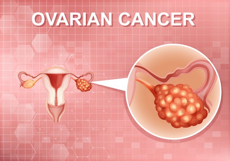 Poster design for human ovarian cancer in human body