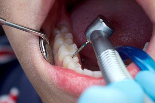 What to Expect During Your Dental Filling Appointment