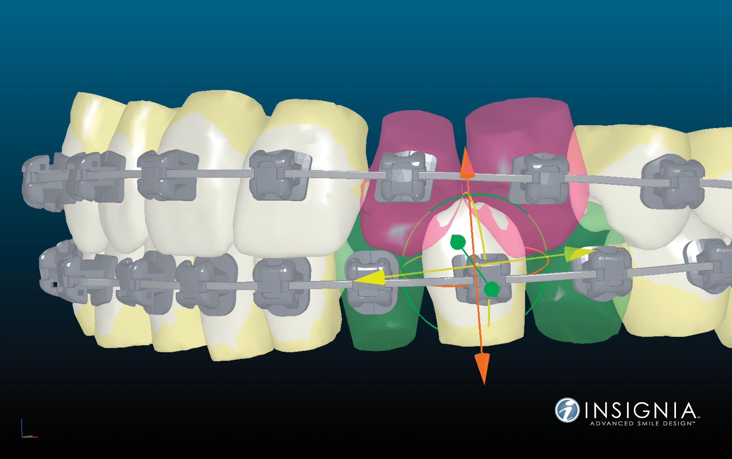 implantes dentales oviedo