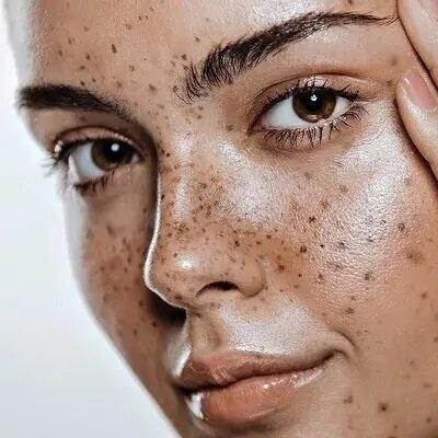 Pigmentation Treatment in Dubai & Abu Dhabi | Best Hyperpigmentation