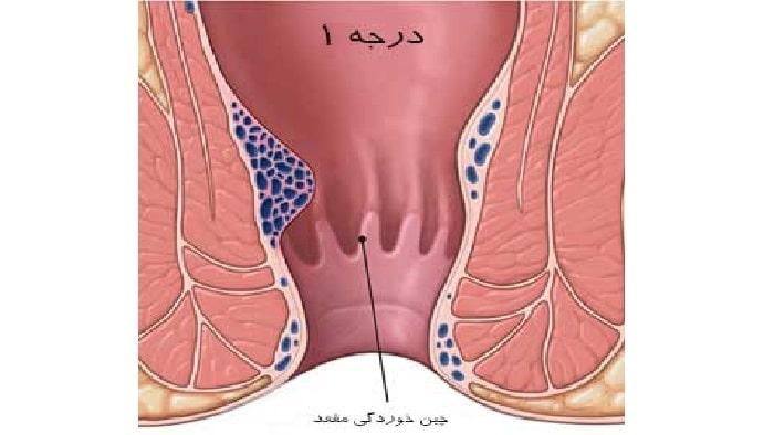 عکس بواسیر داخلی درجه 1