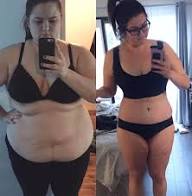 I Lost 150 Pounds After I Had A Vertical Sleeve Gastrectomy'