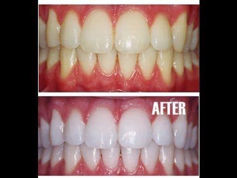 top teeth whitening toothpaste in india