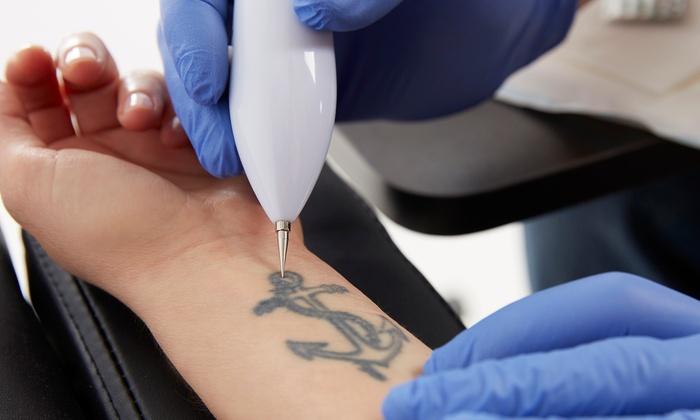 laser tattoo removal services