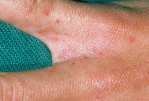 princ_rm_photo_of_scabies_between_finger