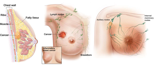 Gambar Kanker Payudara