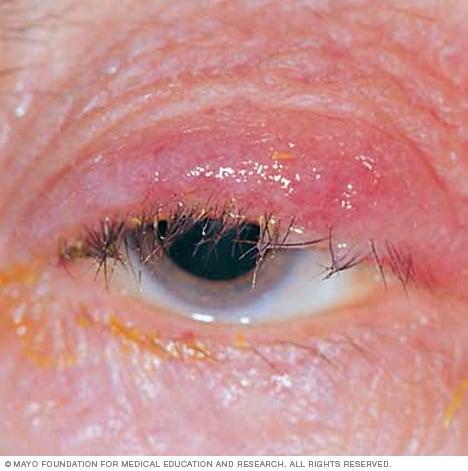 blepharitis eczema