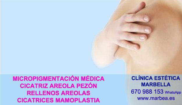 tratamiento de cicatrices post quirúrgicas Camuflaje cicatrices después de reduccion senos Marbella y Motril. Microblading Marbella y San Pedro. en Pigmentacion Marbella y en Torremolinos