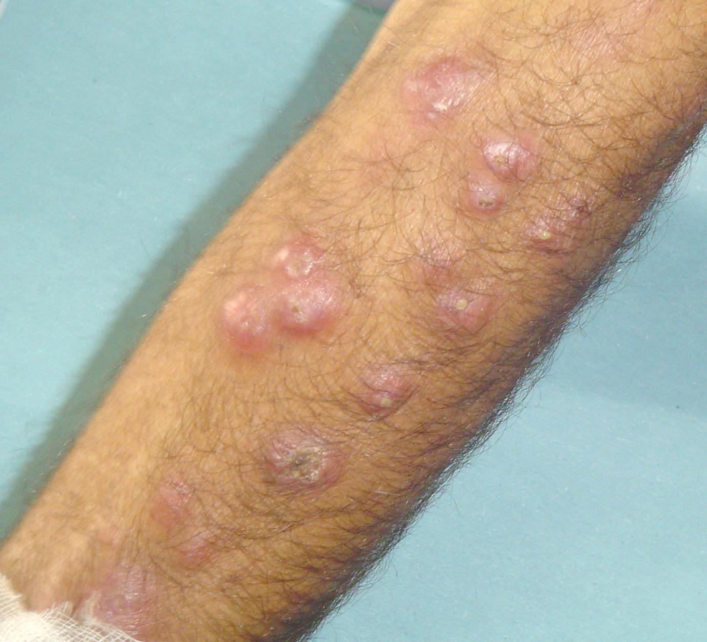 measles- viral infection