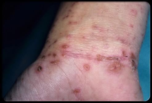 scabies_s5_red_bumps_wrist_small.jpg