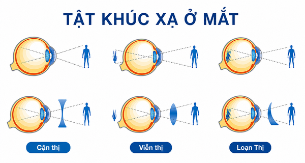 Tật khúc xạ ở mắt