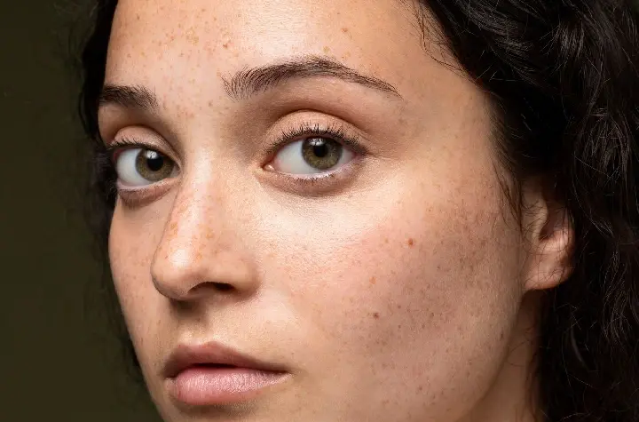 Freckles Treatment in Delhi, Greater Kailash | Delhi Wellness Clinics