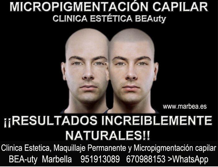 clinica estética, tatuaje capilar en en Marbella y Marbella y maquillaje permanente en marbella ofrece: dermopigmentacion capilar , tatuaje capilar